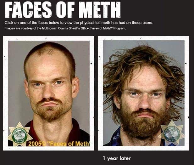 Why Meth Users Have Meth Sores And Scabs On Their Faces Northbound